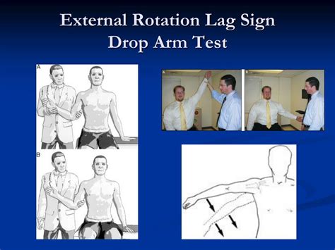 drop arm test|positive hornblower's sign.